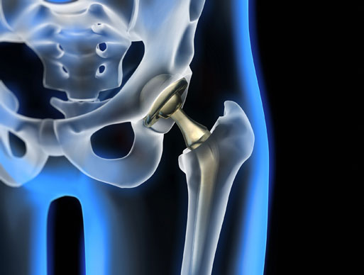 Hip replacement component finishing